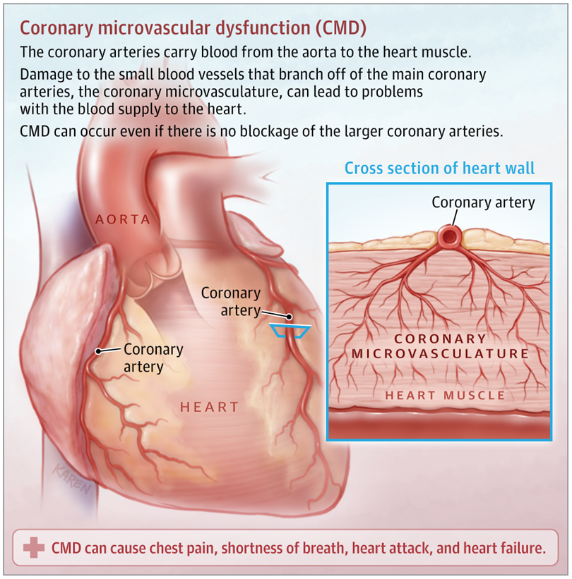 Coronaire microvasculaire disfunctie 