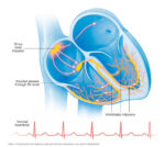 Hartritmeproblemen (hartritmestoornissen) treden op wanneer de elektrische impulsen die uw hartslag coördineren niet goed werken, waardoor uw hart te snel, te langzaam of onregelmatig gaat kloppen. 